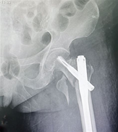 Typical Case Of Internal Fixation From A Patient With Hip Fracture A