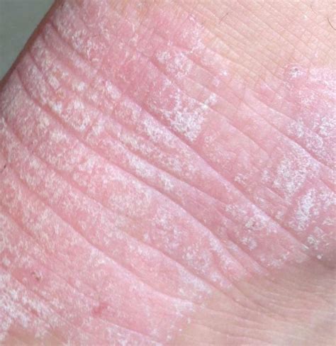 Dermatitis Herpetiformis Causes Treatment And Pictures