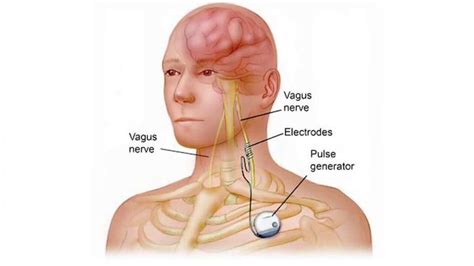 Important Methods To Stimulate Your Vagus Nerve Look4ward