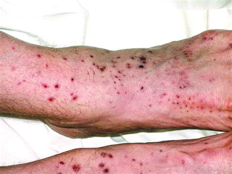 Mksap Quiz 8 Week History Of A Spreading Rash Im Matters From Acp