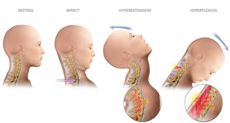 Cervicalgia Or Neck Pain What Are The Causes And Treatment Options