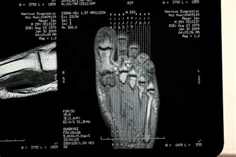 How My Foot Looks Using Mri Fascinating Why Possible Mor Flickr