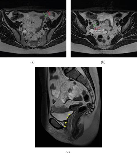 Figure 1 From Role Of Imaging In The Diagnosis And Management Of Complete Androgen Insensitivity