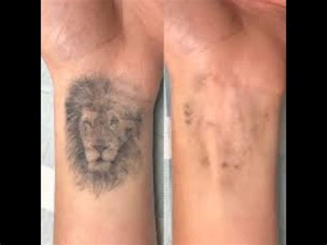 So you want to remove your tattoo without spending thousands of dollar on laser treatment then here we have reviewed some of the best tattoo removal modao is another most effective cream for permanent tattoos. How To Remove Permanent Tattoo Naturally - YouTube