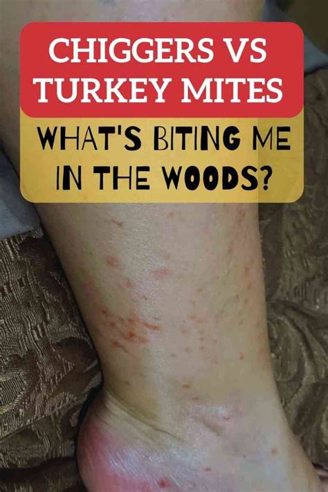 Chiggers Vs Turkey Mites Whats Biting Me In The Woods Kowalski