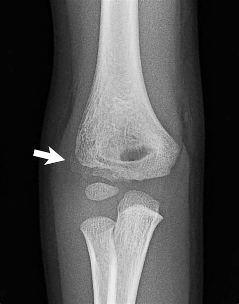 Elbow Grease Lateral And Medial Condyle Fractures Of The Humerus My