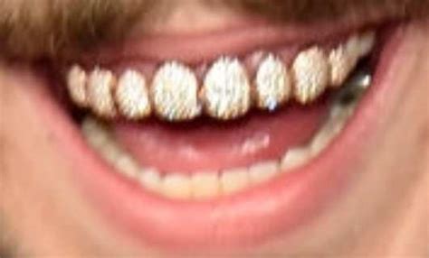 'post malone literally has $1 million smile!!!' Post Malone's Teeth Pictures