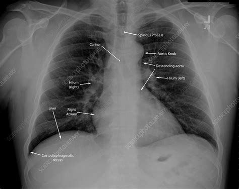 Normal Chest X Ray With Labels Stock Image C036 6419 Science