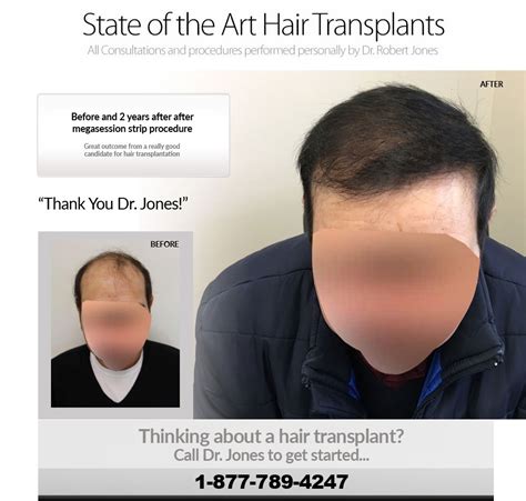 before and after strip procedure toronto hair transplant surgeons