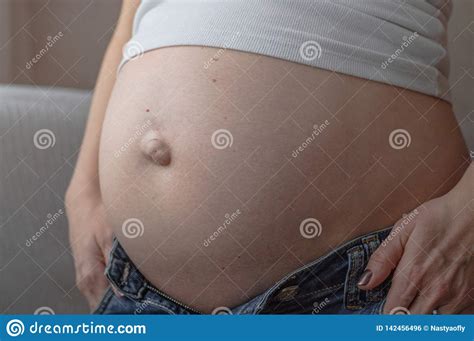 Umbilical Hernia In A Pregnant Woman Closeup Stock Photo Image Of
