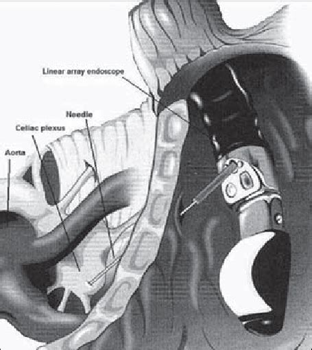 Picture Of An Endoscopic Ultrasound Eus Guided Celiac Plexus Block