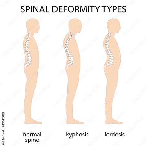 Spine Deformity Vector Illustration Kyphosis Lordosis Spine