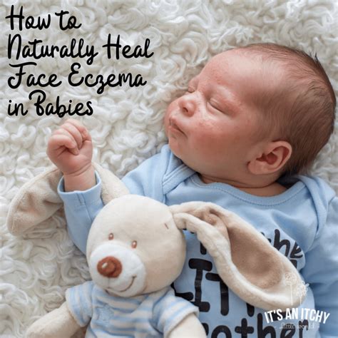 Common rashes & treatments for babies, toddlers & children. Face Eczema in Babies: How To Naturally Treat It | It's an ...