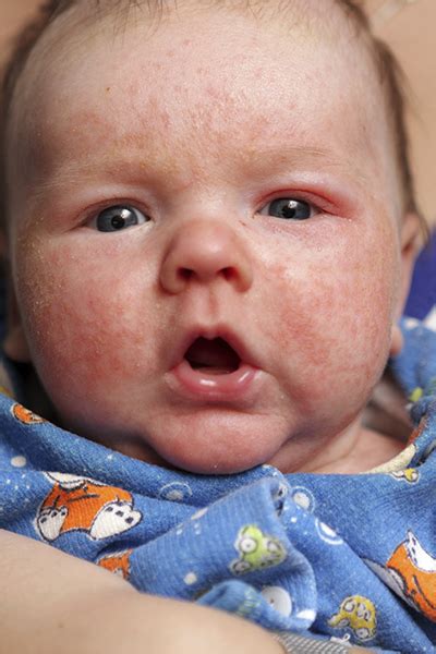How To Find Out If Your Babys Rash Might Lead To Asthma Philadelphia