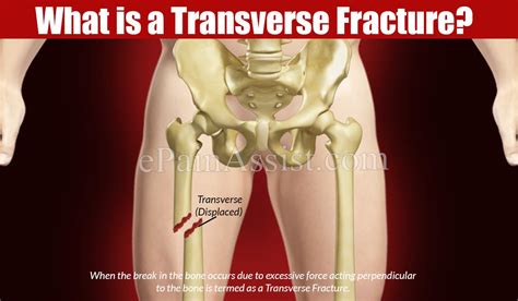What Is Transverse Fracture How Long Does It Take To Heal Causes