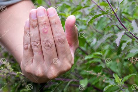 Paronychia Swollen Finger Inflammation Due To Bacterial Infection On A