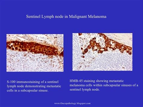 Melanoma Sentinel Lymph Node