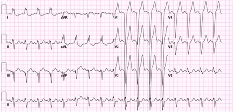 Intraventricular Conduction Ecgpedia