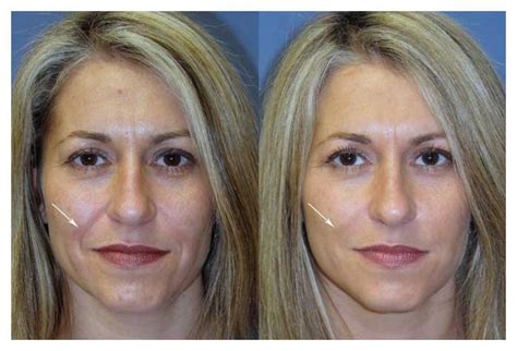 Injectable Fillers Raleigh Nc Dr William Stoeckel