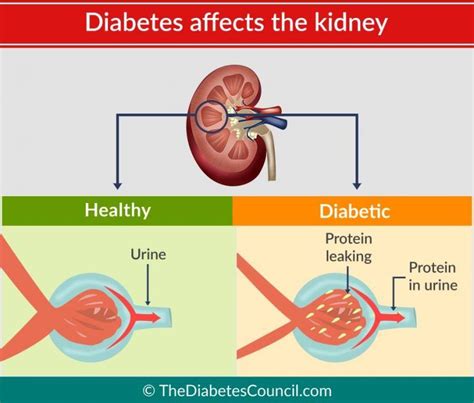 Diabetes And Renal Failure Everything You Need To Know In 2021 Renal