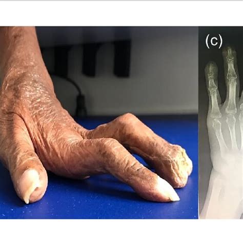 Pdf A Rare Case Of Acrodermatitis Continua Of Hallopeau Successfully