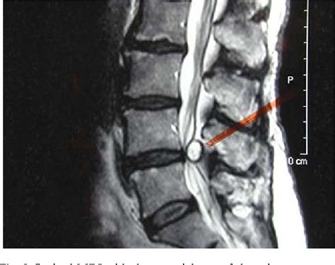 Synovial Cyst Lumbar Spine Removal Mapametawan