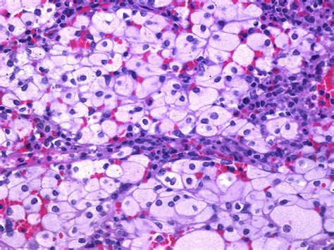 These cells malfunction and, over time, die. Niemann-Pick disease. Causes, symptoms, treatment Niemann-Pick disease