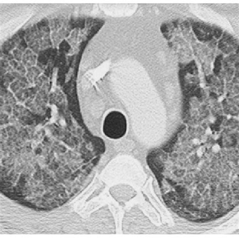 Ct Scan Of The Chest Of A Patient With Pap Before Left And After