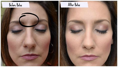 Botox Between Eyebrows Before And After Eyebrowshaper