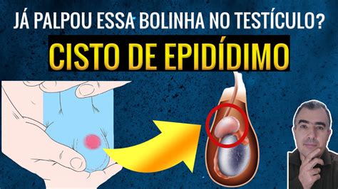 Cisto Na Cabeça Do Epididimo
