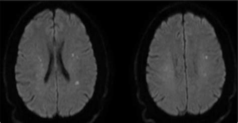 Mri Brain Dwi Showing Multiple Small Infarcts In The Centrum Semiovale