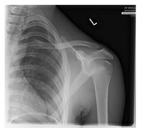 Ap X Ray Indicating Minimally Displaced Mid Clavicle Fracture