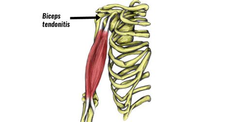 Biceps Tendonitis Tendinopathy In The Shoulder Symptoms And Treatment