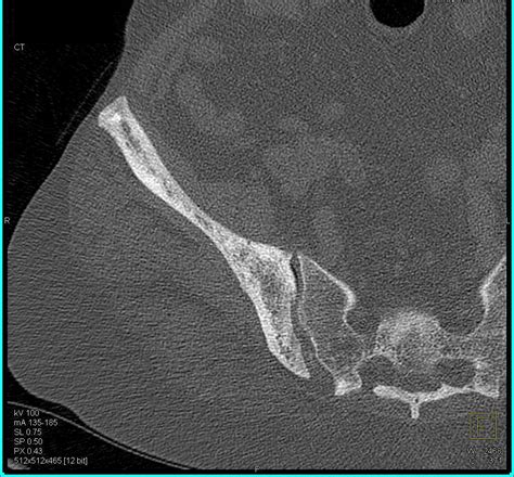 Sclerotic Changes Right Iliac Bone - Musculoskeletal Case Studies