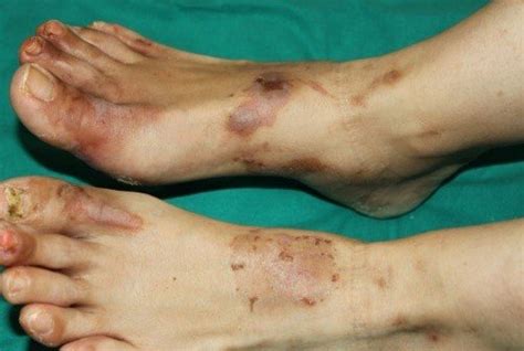 Necrolytic Migratory Erythema Obligate Paraneoplastic Dermatosis