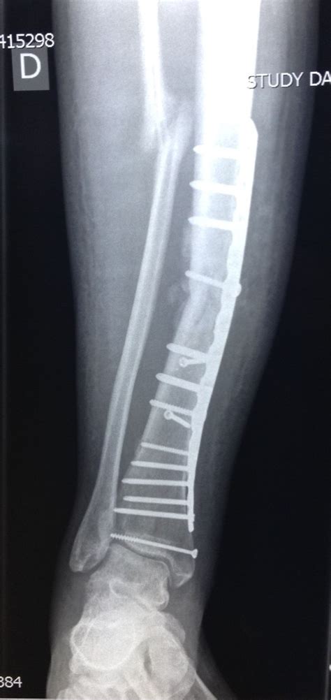 Management Of A Complex Tib Fib Fracture After Delayed Union
