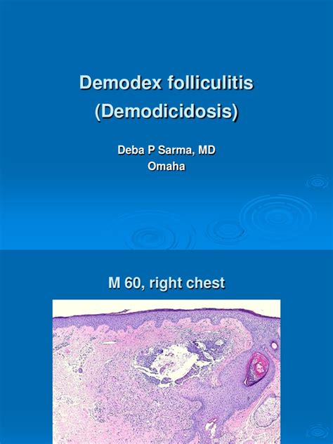 Demodex Folliculitis M 60 Chest Pdf Medical Specialties