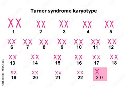 Turner Syndrome Karyotype Stock Vektorgrafik Adobe Stock