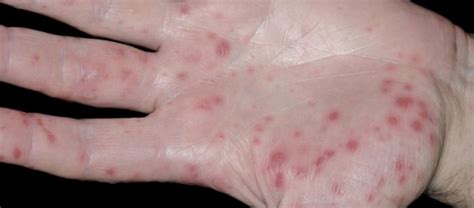 Hand Foot And Mouth Disease Lesions