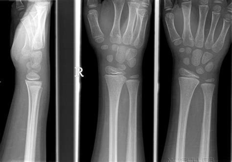 Paediatric Wrist Trauma Wikiradiography