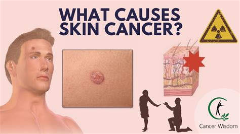 The Skin Cancer Mystery Revealed Why People Get Skin Cancer Melanoma