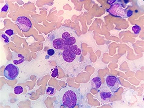 Morbus hodgkin (hodgkin krankheit, lymphgranulomatose) ist ein bösartiger tumor des lymphsysthems (lymphom). Hodgkin/Reed-Sternberg cell (Wright stain)