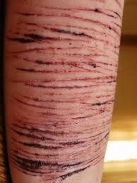 What It Looks Like Self Harm Is Not At All Ok