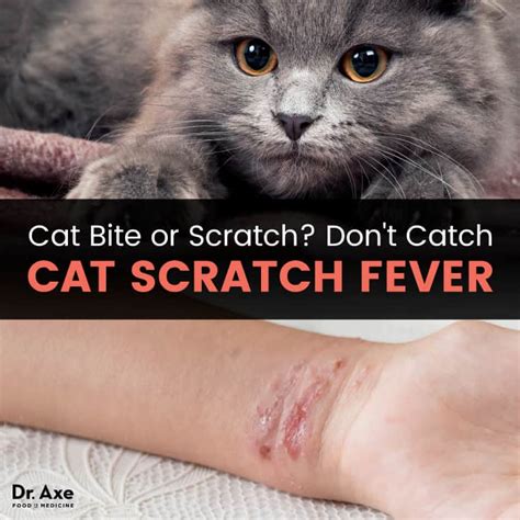 Cat Scratch Fever See Your Doctor Find Natural Relief Dr Axe