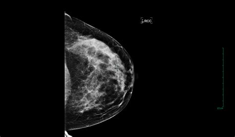 Mammograms Showing Breast Cancer