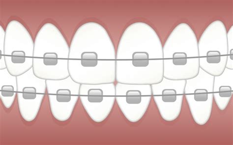 How Braces Are Linked With Swollen And Irritated Gums Angel Orthodontics