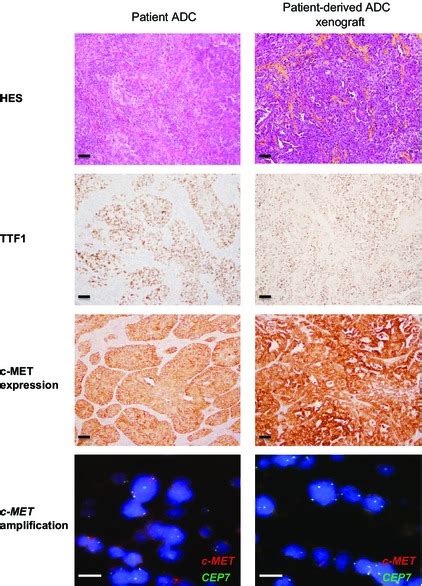 Pdx Models Of Lung Adenocarcinoma Adc Specimens Recapitulate Primary Download Scientific