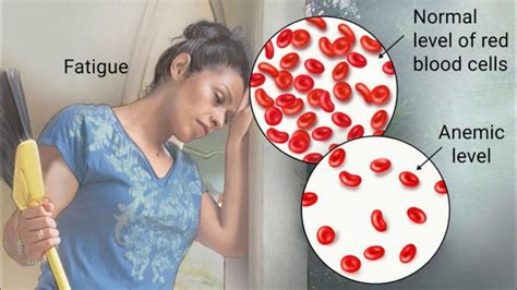 Anemia Causes Types Signs Symptoms Diagnosis Test Treatment