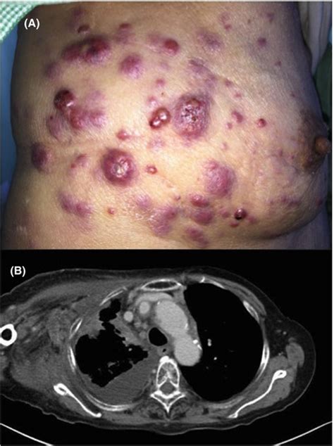 Cutaneous Metastases Of Lung Cancer Fukuda Clinical Case Reports