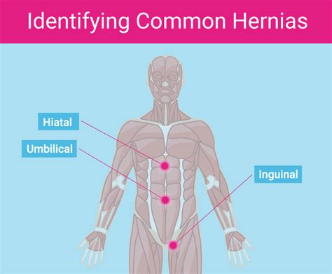 It was repaired through a midline incision with mesh. 5 Signs You Have Hernia Mesh Complications | by MedTruth ...